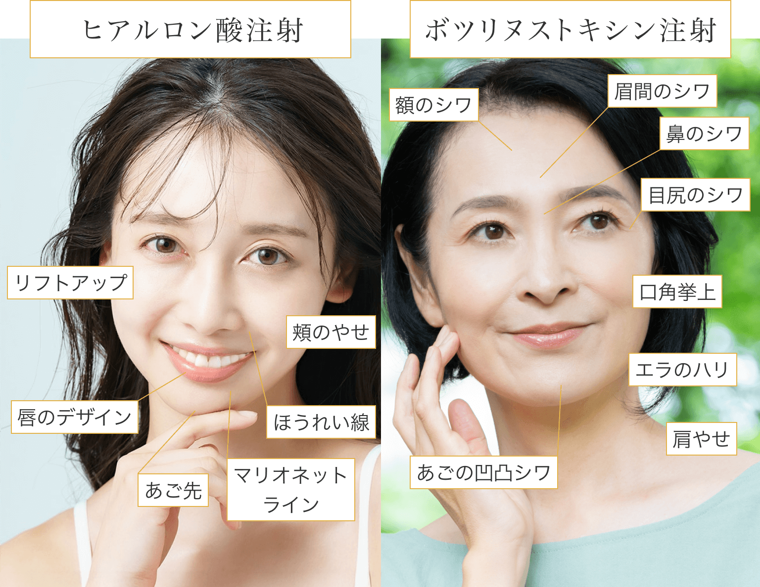 ヒアルロン酸注射の施術例として、リフトアップ/頬のやせ/唇のデザイン/ほうれい線/あご先/マリオネットラインへの施術が可能です。ボツリヌストキシン注射の施術例として、額のシワ/眉間のシワ/鼻のシワ/目尻のシワ/口角挙上/エラのハリ/あごの凸凹シワ/肩やせといった施術が可能です。