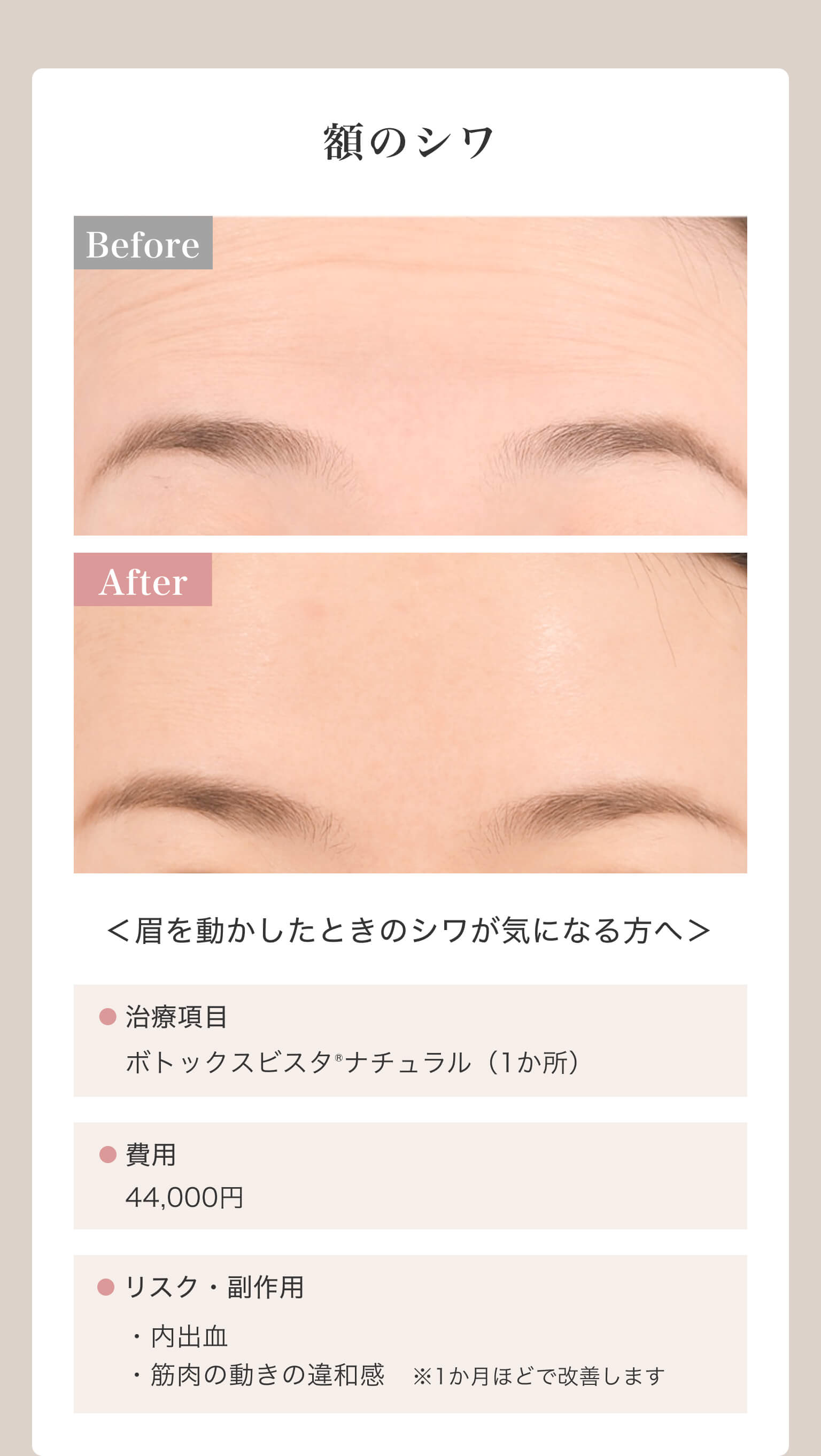 額のシワ｜＜眉を動かしたときのシワが気になる方へ＞｜治療項目/ボトックスビスタ®ナチュラル（1か所）｜費用/44,000円｜リスク・副作用/・内出血・筋肉の動きの違和感※1か月ほどで改善します