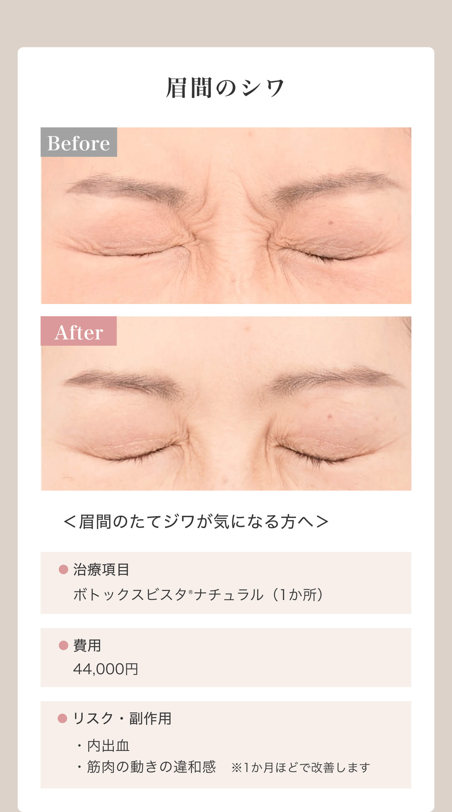 眉間のシワ｜＜眉間のたてジワが気になる方へ＞｜治療項目/ボトックスビスタ®ナチュラル（1か所）｜費用/44,000円｜リスク・副作用/・内出血・筋肉の動きの違和感※1か月ほどで改善します
