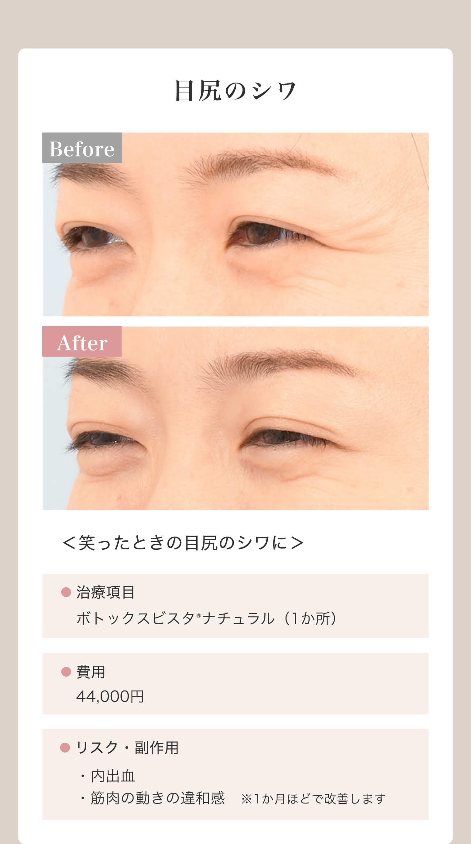 目尻のシワ｜＜笑ったときの目尻のシワに＞｜治療項目/ボトックスビスタ®ナチュラル（1か所）｜費用/44,000円｜リスク・副作用/・内出血・筋肉の動きの違和感※1か月ほどで改善します