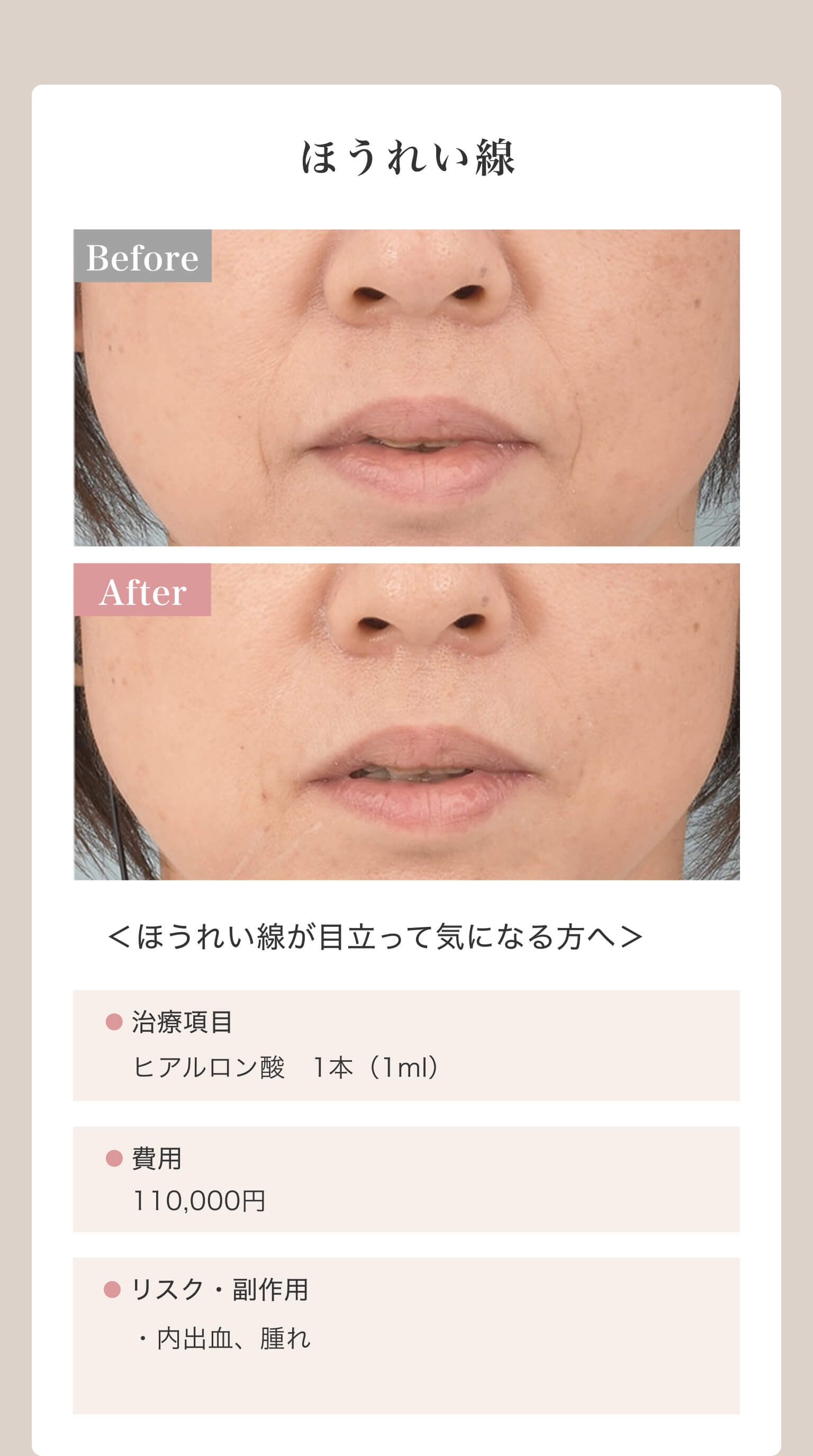 ほうれい線｜＜ほうれい線が目立って気になる方へ＞｜治療項目/ヒアルロン酸1本（1ml）｜費用/110,000円｜リスク・副作用/・内出血、腫れ