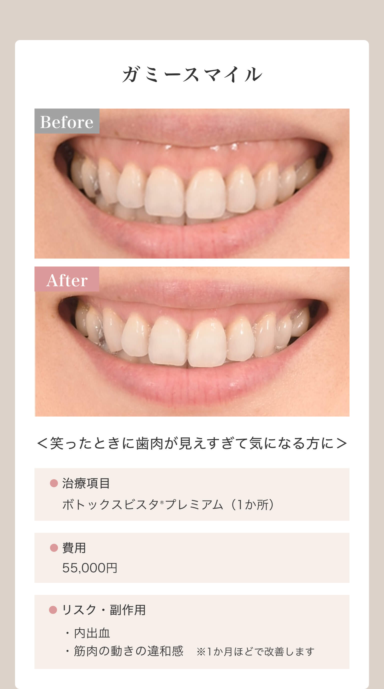 ガミースマイル｜＜笑ったときに歯肉が見えすぎて気になる方に＞｜治療項目/ボトックスビスタ®プレミアム（1か所）｜費用/55,000円｜リスク・副作用/・内出血・筋肉の動きの違和感※1か月ほどで改善します