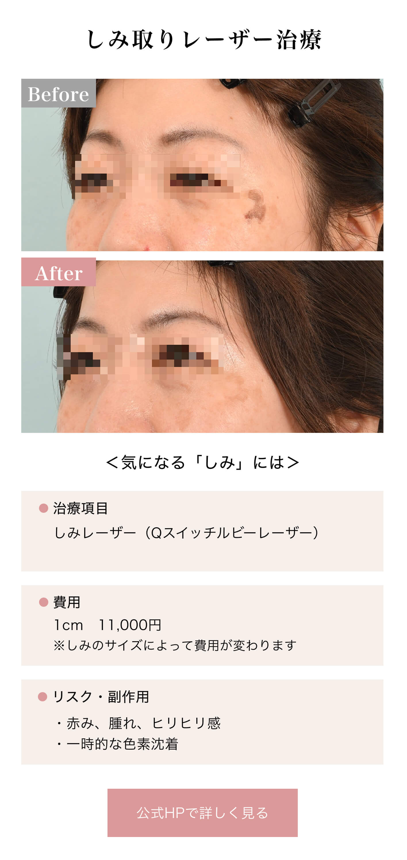 しみ取りレーザー治療｜＜気になる「しみ」には＞｜治療項目/しみレーザー（Qスイッチルビーレーザー）｜費用/1cm　11,000円※しみのサイズによって費用が変わります｜リスク・副作用/・赤み、腫れ、ヒリヒリ感・一時的な色素沈着｜公式HPで詳しく見る