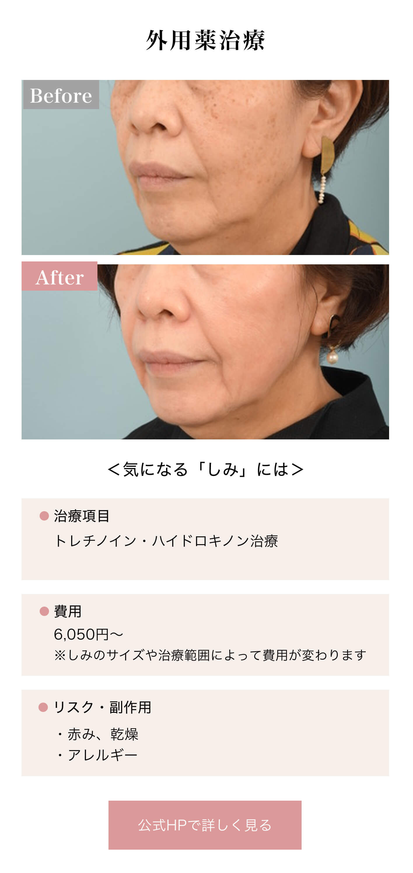 外用薬治療｜＜気になる「しみ」には＞｜治療項目/トレチノイン・ハイドロキノン治療｜費用/6,050円〜※しみのサイズや治療範囲によって費用が変わります｜リスク・副作用/・赤み、乾燥・アレルギー｜公式HPで詳しく見る