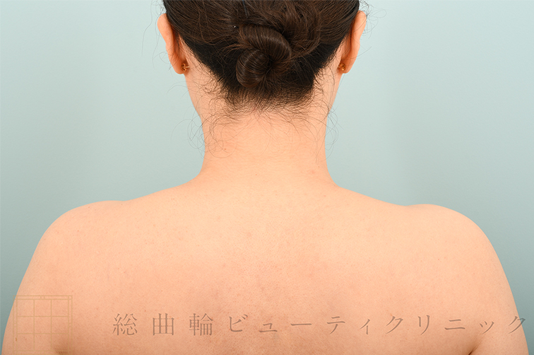 肩ボツリヌストキシン注射で得られる2つの変化