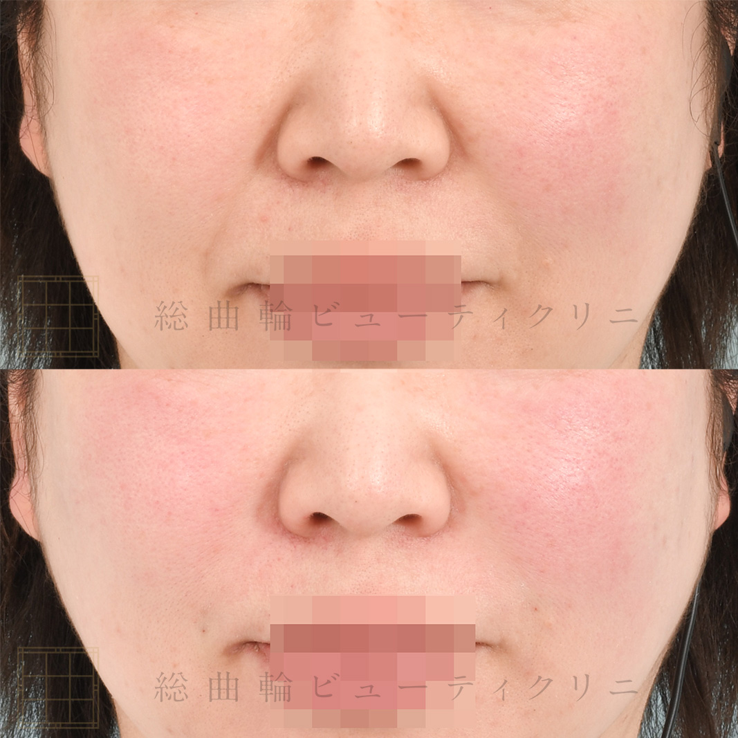鼻翼 症例】ほうれい線・鼻翼基部<br>ヒアルロン酸 - ボツリヌストキシン注射、ヒアルロン酸治療は総曲輪ビューティクリニック／富山市
