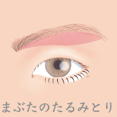 「眉毛下皮膚切除術（眉下切開・眉下リフト）」について