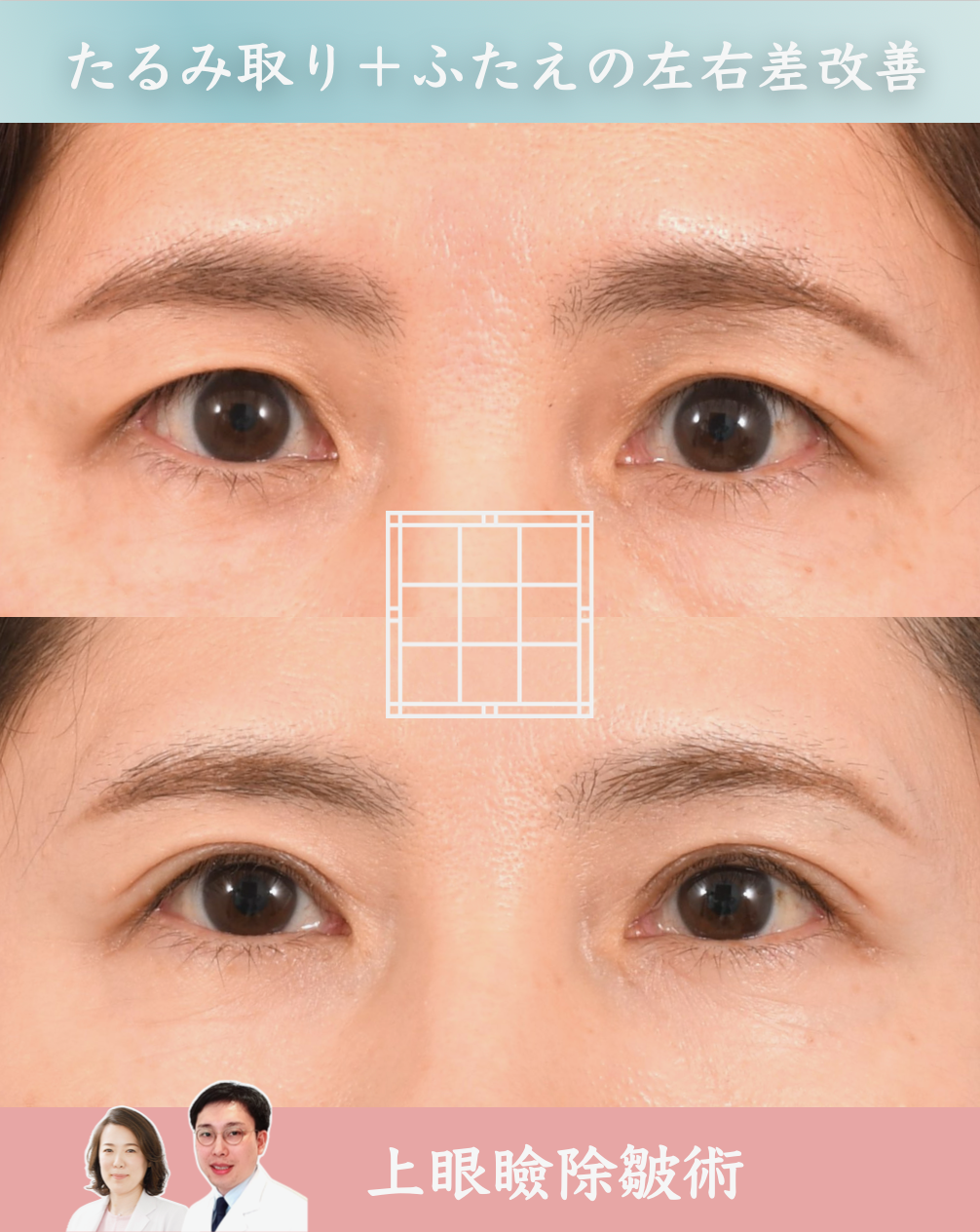 「上眼瞼除皺術(まぶたのたるみとり)」について