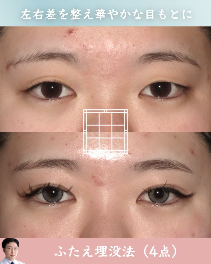 【症例写真】ふたえ埋没法・眉毛下皮膚切除術